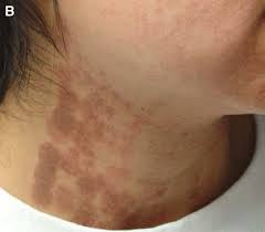 generalized urticaria after laser hair