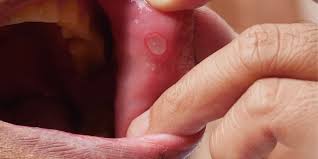 mouth ulcers after drinking alcohol