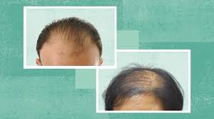 alopecia universalis treatment options