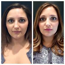 lip enhancement with juvederm ultra