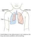 Pleural Effusion - Causes, Symptoms, Types, and Treatments