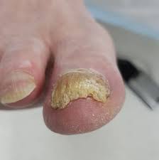 thick toenails cause symptoms