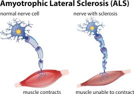 Amyotrophic lateral sclerosis (als), or lou gehrig's disease, is a fatal degenerative neurological condition that causes progressive weakening. Als Scientific Breakthrough Diabetes Drug Metformin Shows Promise In Mouse Study For A Common Type Of Als