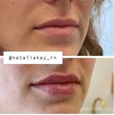 lip fillers los angeles russian lip