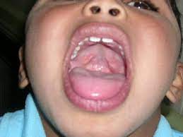 treatment of submucous cleft palate by