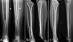 displaced tibia shaft fractures