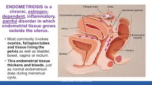 Superficial (peritoneal) disease, ovarian disease (endome. Endometriosis Ciplamed