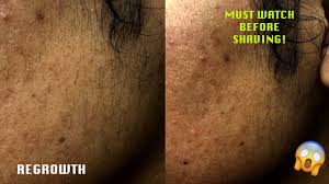 results after shaving derma planing