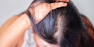 Other causes of hair loss regardless of whether you have sores on head comprise the following things. How To Treat Hair Loss With Diet And Supplements The Guerrilla Diet