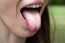 what does early tongue cancer look like