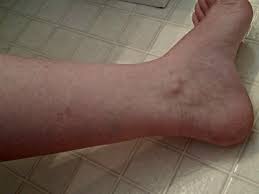 how to easily cover spider veins with