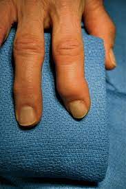 trigger finger surgery recovery hand