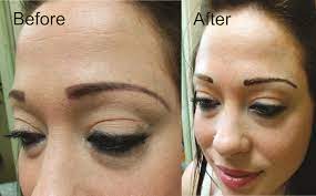 permanent makeup tattoo removal by