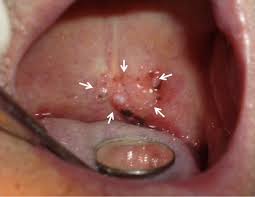 tumor in the middle of the soft palate