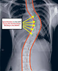 Early Stage Scoliosis Treatment