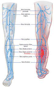 Vor allem entstehen thrombosen bei älteren menschen in den beinen bzw. Tiefe Beinvenenthrombose