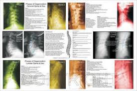 Details About Spinal Degeneration Cervical Lumbar Spine Chiropractic Poster 24 X 36 Chart
