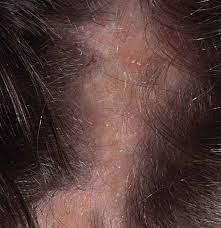 scalp infections causes symptoms