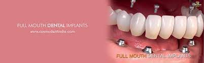 full mouth dental implant treatment