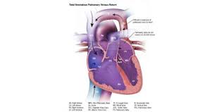 Image result for icd 10 code for partial anomalous pulmonary venous return