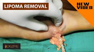 multiple lipoma removal surgery