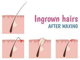 basic tips to prevent ingrown hair
