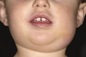 mumps symptoms nhs