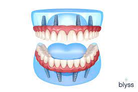 all on 4 dental implants cost your