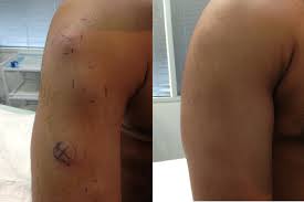 lipoma surgery removal auckland