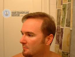 As they lengthen, the hairs become thicker and straighter. Hair Transplant Results After 7 Months