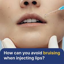avoid bruising when injecting lips