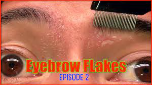 eyebrow flakes 2 dandruff