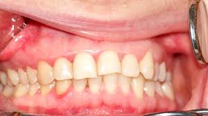 bad bite how malocclusion can shape