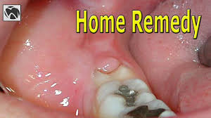 pericoronitis home remedy best