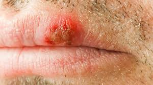 hiv mouth sores what they look like