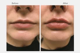 lip fillers everything you need to