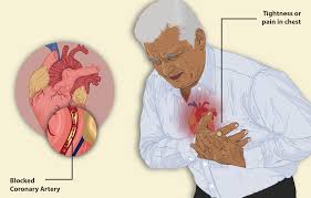 • stable angina occurs because the blood going to the heart muscle is not enough to cover for the extra workload in exercise. Variant Angina Wikipedia