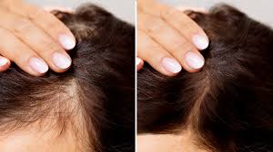 hair loss treatment options goodrx