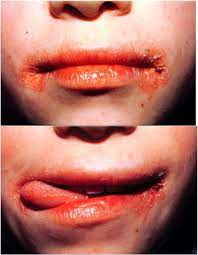 diseases of the lips sciencedirect