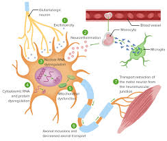 amyotrophic lateral sclerosis concise