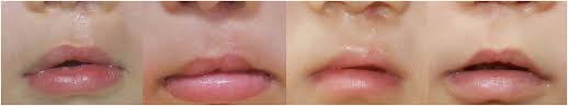 cleft lip scars
