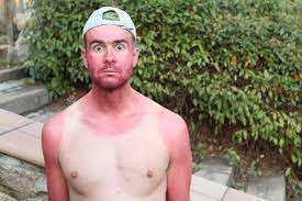 Coup de soleil : comment éviter les excès de bronzage ? – Masculin.com