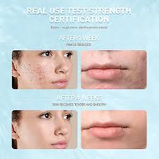 acne treatment face cream salicylic