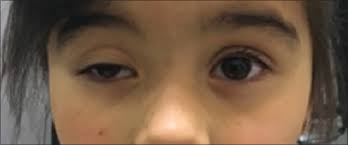 Pediatric ocular myasthenia gravis: Case report and literature review Solano A, Jimeno V, Montoya L, Espinosa N - Pan Am J Ophthalmol