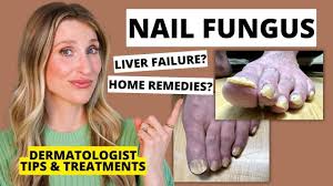 nail fungus prevention tips