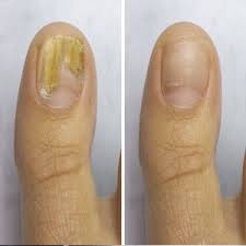 lacuna fungal nail treatment nenagh