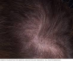 I'd suggest you to first relax as this can be. Hair Loss Symptoms And Causes Mayo Clinic