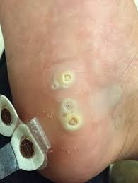 Plantar warts, like all warts, are created by an infection of hpv that enters the skin through a crack, wound or scrape. How To Remove Plantar Warts Naturally Artsea Chic Planter Warts Remedies Warts Warts Remedy