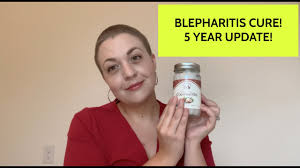 my blepharitis cure 5 years later