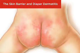 the skin barrier and diaper dermais